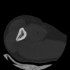 SPORK, NICO - 22.03.1976 - 02.08.2022 - CT obere Extremität - 17:59:38